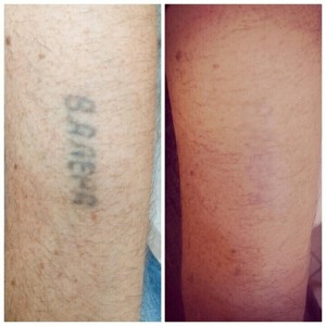 Удаление татуировок лазером Фото 3